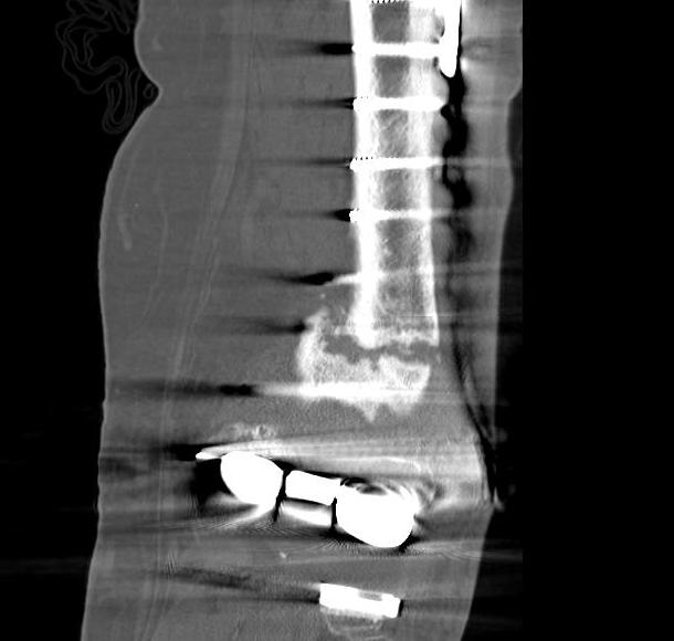 Periprosthetic TKR Locking Plate Nonunion 30001